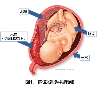 図１．常位胎盤早期剥離